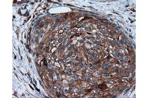 Immunohistochemical staining of paraffin-embedded Carcinoma of liver tissue using anti-RC201933 mouse monoclonal antibody. (PIM2 antibody)