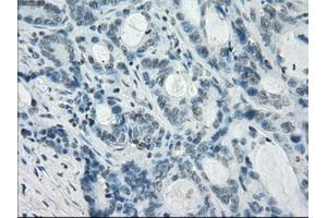 Immunohistochemical staining of paraffin-embedded Adenocarcinoma of colon tissue using anti-CRYABmouse monoclonal antibody. (CRYAB antibody)