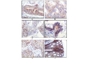Immunohistochemical analysis of paraffin-embedded human gastric adenocarcinoma(A), colon adenocarcinoma(B), endometrial carcinoma(uterus)(C), ovary adenocarcinoma(D), lung squamous cell carcinoma(E), stomach epithelium mucosae(F), showing membrane localization using IGF1R-Beta mouse mAb with DAB staining. (IGF1R-beta antibody)
