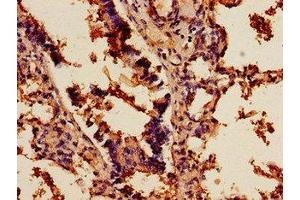 Immunohistochemistry of paraffin-embedded human lung cancer using ABIN7143196 at dilution of 1:100 (SCD antibody  (AA 10-70))