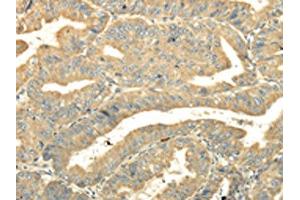 The image on the left is immunohistochemistry of paraffin-embedded Human esophagus cancer tissue using ABIN7131516(TULP2 Antibody) at dilution 1/20, on the right is treated with fusion protein. (TULP2 antibody)