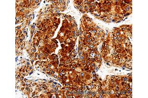 Immunohistochemistry of Human liver cancer using COX19 Polyclonal Antibody at dilution of 1:50 (COX19 antibody)