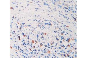 IHC-P analysis of stomach cancer tissue, with DAB staining.
