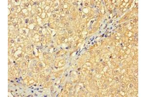 Immunohistochemistry of paraffin-embedded human liver cancer using ABIN7166961 at dilution of 1:100 (RABGAP1L antibody  (Isoform 10))