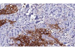 ABIN6278038 at 1/100 staining Human Head and neck cancer tissue by IHC-P.