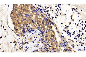 Detection of XIAP in Human Breast cancer Tissue using Polyclonal Antibody to X-linked Inhibitor Of Apoptosis Protein (XIAP) (XIAP antibody  (AA 1-497))