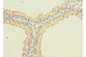 Immunohistochemistry of paraffin-embedded human prostate cancer using ABIN7169984 at dilution of 1:100 (SLC6A15 antibody  (AA 357-452))
