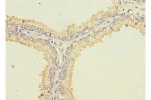 Immunohistochemistry of paraffin-embedded human prostate cancer using ABIN7169984 at dilution of 1:100