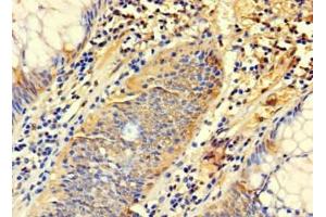 Immunohistochemistry of paraffin-embedded human colon cancer using ABIN7171165 at dilution of 1:100 (SYTL3 antibody  (AA 1-300))