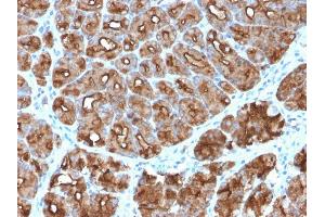 Formalin-fixed, paraffin-embedded human Stomach Carcinoma stained with MUC1 Rabbit Recombinant Monoclonal Antibody (MUC1/2818R). (Recombinant MUC1 antibody)