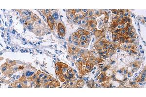 Immunohistochemistry of paraffin-embedded Human lung cancer using CD54 Polyclonal Antibody at dilution of 1:30 (ICAM1 antibody)