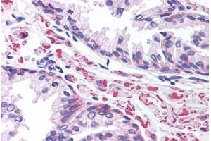 Human Prostate (formalin-fixed, paraffin-embedded) stained with LEF1 antibody ABIN214792 at 5 ug/ml followed by biotinylated goat anti-rabbit IgG secondary antibody ABIN481713, alkaline phosphatase-streptavidin and chromogen. (LEF1 antibody  (AA 51-100))