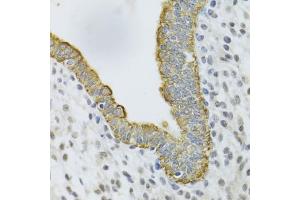 Immunohistochemistry of paraffin-embedded human uterine cancer using KRT5 Antibody (ABIN5971441) at dilution of 1/100 (40x lens). (Cytokeratin 5 antibody)