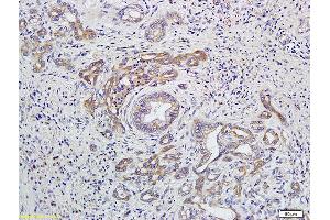 Formalin-fixed and paraffin embedded human colon cancer labeled with Anti-EDG4/LPA2 Polyclonal Antibody, Unconjugated (ABIN681118) at 1:400 followed by conjugation to the secondary antibody and DAB staining (EDG4 antibody)