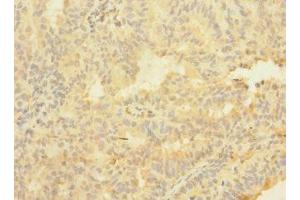 Immunohistochemistry of paraffin-embedded human endometrial cancer using ABIN7144765 at dilution of 1:100 (ASTL antibody  (AA 38-337))