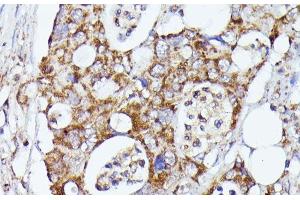 Immunohistochemistry of paraffin-embedded Human colon carcinoma using CDK5RAP1 Polyclonal Antibody at dilution of 1:100 (40x lens). (CDK5RAP1 antibody)