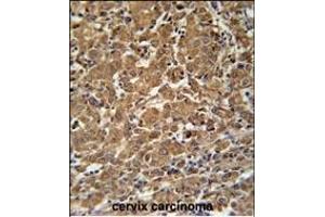 N4BP3 Antibody (N-term) (ABIN651821 and ABIN2840413) immunohistochemistry analysis in formalin fixed and paraffin embedded human cervix carcinoma followed by peroxidase conjugation of the secondary antibody and DAB staining. (N4BP3 antibody  (N-Term))