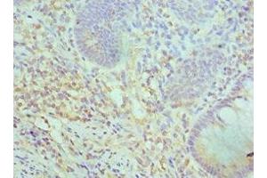Immunohistochemistry of paraffin-embedded human colon cancer using ABIN7171057 at dilution of 1:100 (SMARCC2 antibody  (AA 300-650))
