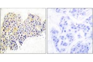 Immunohistochemistry analysis of paraffin-embedded human breast carcinoma tissue, using HSP90B (Ab-254) Antibody. (HSP90AB1 antibody  (AA 226-275))