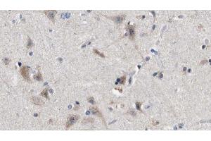 ABIN6272845 at 1/100 staining Human brain cancer tissue by IHC-P. (IFT88 antibody  (C-Term))
