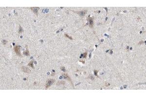 ABIN6272845 at 1/100 staining Human brain cancer tissue by IHC-P.