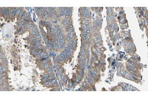 ABIN6274763 at 1/100 staining Human cervical cancer tissue by IHC-P. (AZI1 antibody  (C-Term))