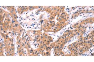 Immunohistochemistry of paraffin-embedded Human lung cancer using SERPINA5 Polyclonal Antibody at dilution of 1:40 (SERPINA5 antibody)