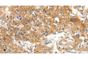 Immunohistochemistry of paraffin-embedded Human lung cancer using PLAT Polyclonal Antibody at dilution of 1:50 (PLAT antibody)