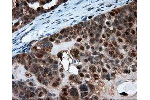 Immunohistochemical staining of paraffin-embedded Adenocarcinoma of breast tissue using anti-SRR mouse monoclonal antibody. (SRR antibody)