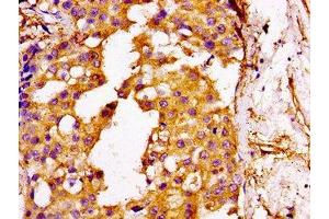 IHC image of ABIN7175537 diluted at 1:100 and staining in paraffin-embedded human breast cancer performed on a Leica BondTM system. (GGCX antibody  (AA 383-526))