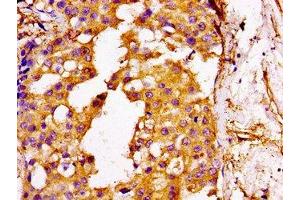 IHC image of ABIN7175537 diluted at 1:100 and staining in paraffin-embedded human breast cancer performed on a Leica BondTM system.