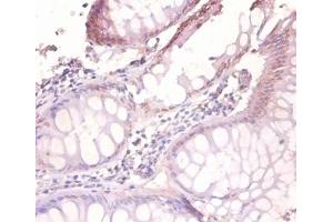 Immunohistochemistry of paraffin-embedded human colorectal carcinoma using VAMP7 / SYBL1 / T1 VAMP antibody at dilution of 1:100. (VAMP7 antibody  (Biotin))