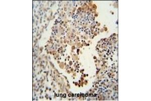 CADM1 antibody (N-term) (ABIN654660 and ABIN2844356) immunohistochemistry analysis in formalin fixed and paraffin embedded human lung carcinoma followed by peroxidase conjugation of the secondary antibody and DAB staining. (CADM1 antibody  (N-Term))