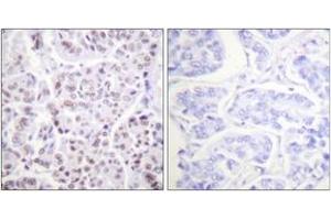Immunohistochemistry analysis of paraffin-embedded human breast carcinoma tissue, using Histone H4 (Acetyl-Lys5) Antibody. (Histone H4 antibody  (acLys5))