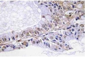 Immunohistochemistry (IHC) analyzes of p-Cofilin in paraffin-embedded human lung carcinoma tissue. (Cofilin antibody  (pSer3))