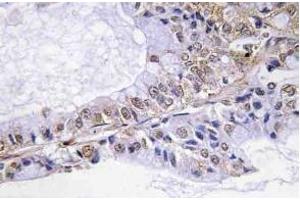 Immunohistochemistry (IHC) analyzes of p-Cofilin in paraffin-embedded human lung carcinoma tissue. (Cofilin antibody  (pSer3))