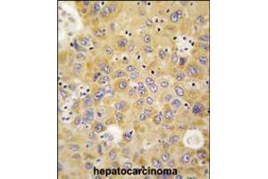 Formalin-fixed and paraffin-embedded human hepatocarcinoma tissue reacted with AARS antibody , which was peroxidase-conjugated to the secondary antibody, followed by DAB staining. (AARS2 antibody  (N-Term))