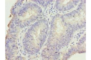 Immunohistochemistry of paraffin-embedded human endometrial cancer using ABIN7165250 at dilution of 1:100 (DDI2 antibody  (AA 1-211))