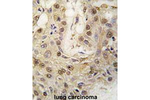 Formalin-fixed and paraffin-embedded human lung carcinomareacted with PRKG2 polyclonal antibody , which was peroxidase-conjugated to the secondary antibody, followed by AEC staining. (PRKG2 antibody  (C-Term))
