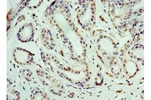 Immunohistochemistry of paraffin-embedded human breast cancer using ABIN7164185 at dilution of 1:100 (BCAS2 antibody  (AA 1-225))
