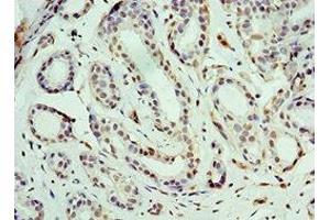 Immunohistochemistry of paraffin-embedded human breast cancer using ABIN7164185 at dilution of 1:100