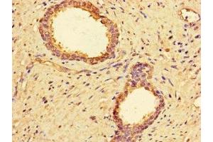 Immunohistochemistry of paraffin-embedded human prostate cancer using ABIN7142866 at dilution of 1:100 (MMP2 antibody  (AA 445-660))