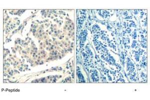 Immunohistochemical analysis of paraffin-embedded human breast carcinoma tissue using ABL1/ABL2 (phospho Y393/429) polyclonal antibody . (ABL1 antibody  (pTyr393, pTyr429))