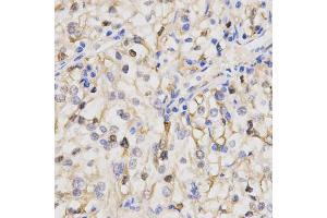 Immunohistochemistry of paraffin-embedded human kidney cancer using PPP2R4 Antibody. (PPP2R4 antibody)