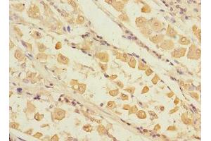 Immunohistochemistry of paraffin-embedded human gastric cancer using ABIN7168232 at dilution of 1:100 (RCHY1 antibody  (AA 1-261))