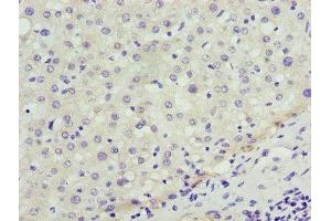 Immunohistochemistry of paraffin-embedded human liver cancer using ABIN7151358 at dilution of 1:100