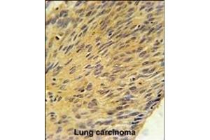 MURC Antibody (N-term) (ABIN651833 and ABIN2840416) immunohistochemistry analysis in formalin fixed and paraffin embedded human lung carcinoma followed by peroxidase conjugation of the secondary antibody and DAB staining. (MURC antibody  (N-Term))