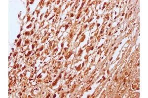 IHC image of ABIN7127796 diluted at 1:100 and staining in paraffin-embedded human melanoma cancer performed on a Leica BondTM system. (Recombinant RNF2 antibody)