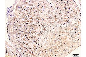 Formalin-fixed and paraffin embedded human myocardium tissue labeled with Anti-Collagen III Polyclonal Antibody (ABIN669981), Unconjugated at 1:400, followed by conjugation to the secondary antibody and DAB staining