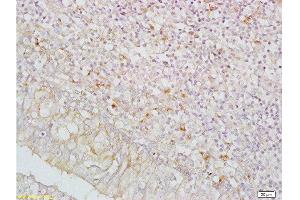Formalin-fixed and paraffin embedded human nasopharyngeal carcinoma labeled with Anti-IGFBP5/IBP5 Polyclonal Antibody , Unconjugated at 1:200, followed by conjugation to the secondary antibody and DAB staining